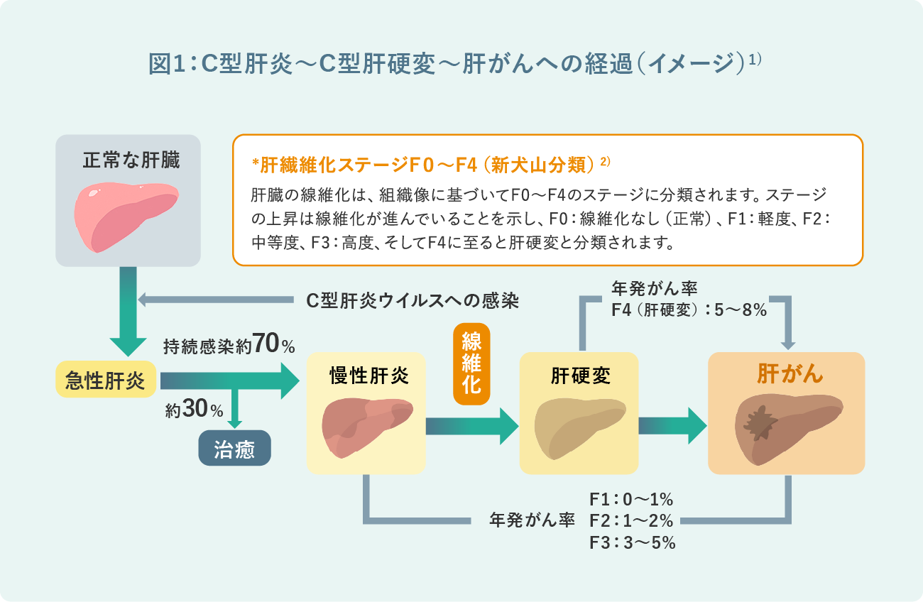 図1：C型肝炎～C型肝硬変～肝がんへの経過（イメージ）
