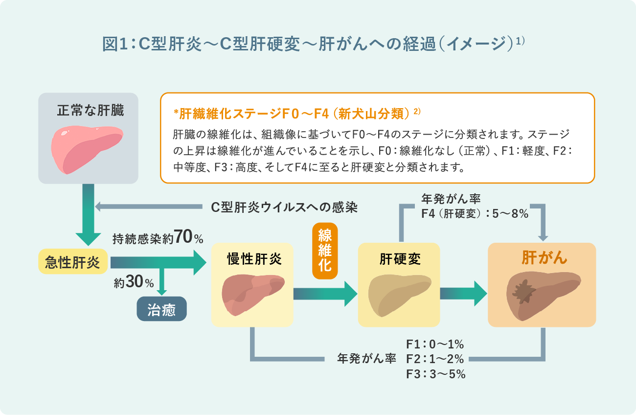 図1:C型肝炎~C型肝硬変~肝がんへの経過(イメージ)