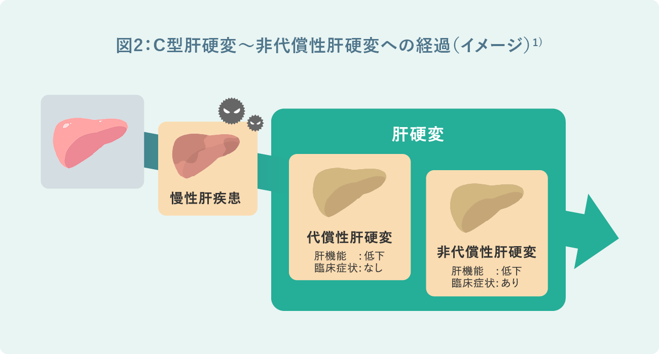 図2：C型肝硬変～非代償性肝硬変への経過（イメージ）